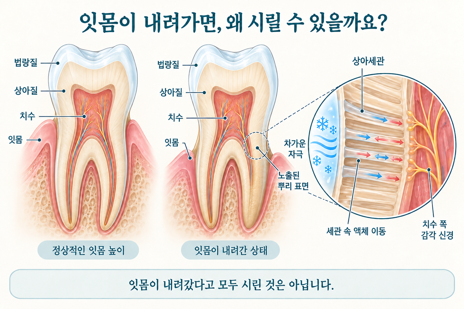 잇몸이 치아 목 부근을 덮는 치아와 잇몸 퇴축으로 뿌리가 드러난 치아를 비교한 단면도. 확대 그림은 열린 상아세관 속 액체 이동과 치수 쪽 감각 신경의 반응을 보여준다.