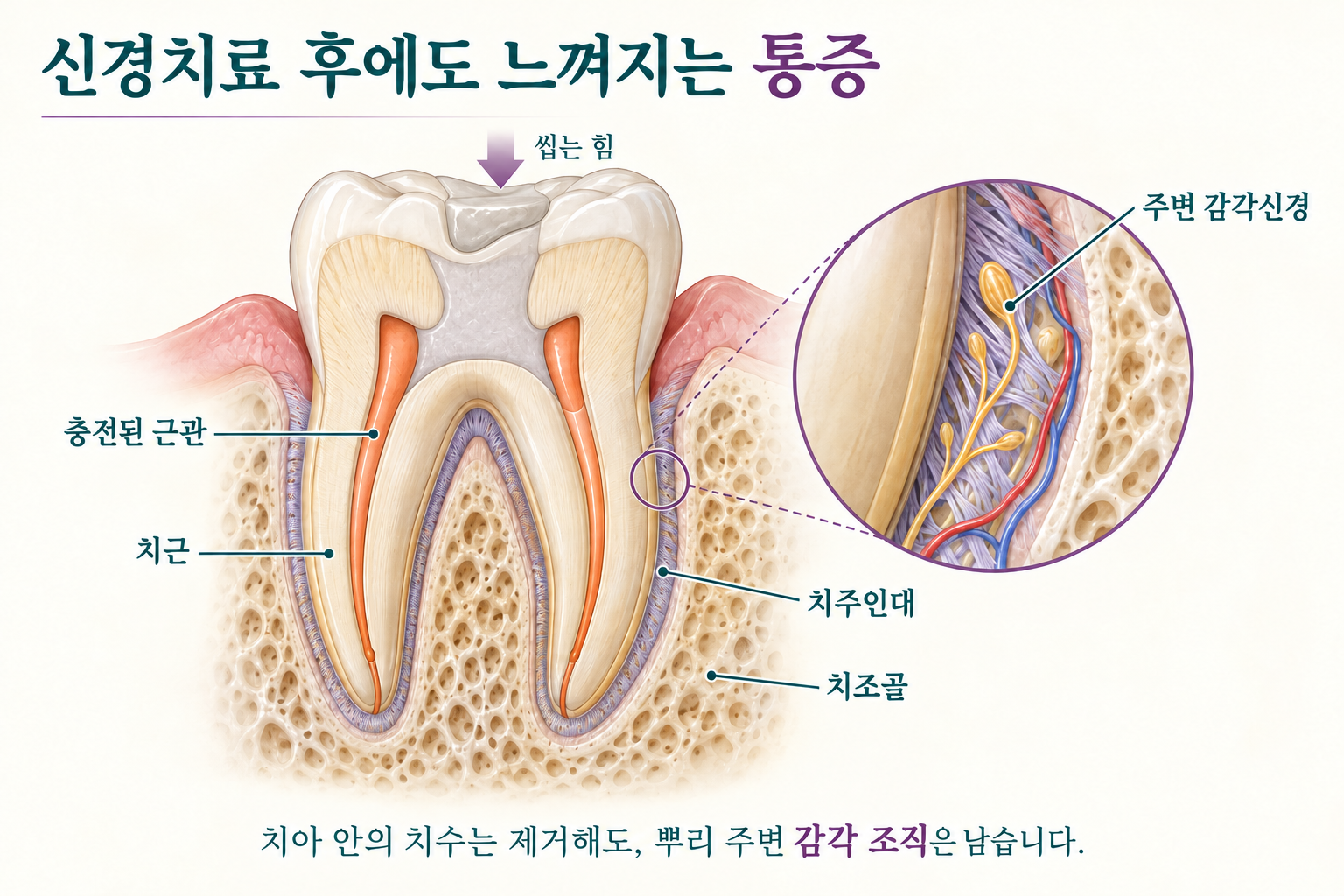 근관을 충전한 어금니의 단면. 치근 바깥의 치주인대와 치조골을 구분하고, 확대도에서 치주인대의 감각신경을 보여 준다.