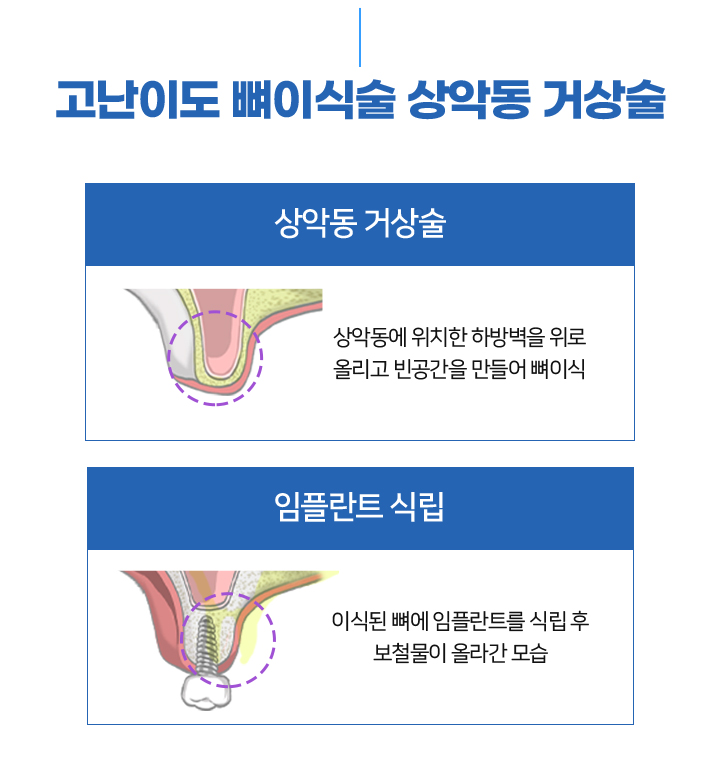 고난이도 뼈이식술 상악동 거상술