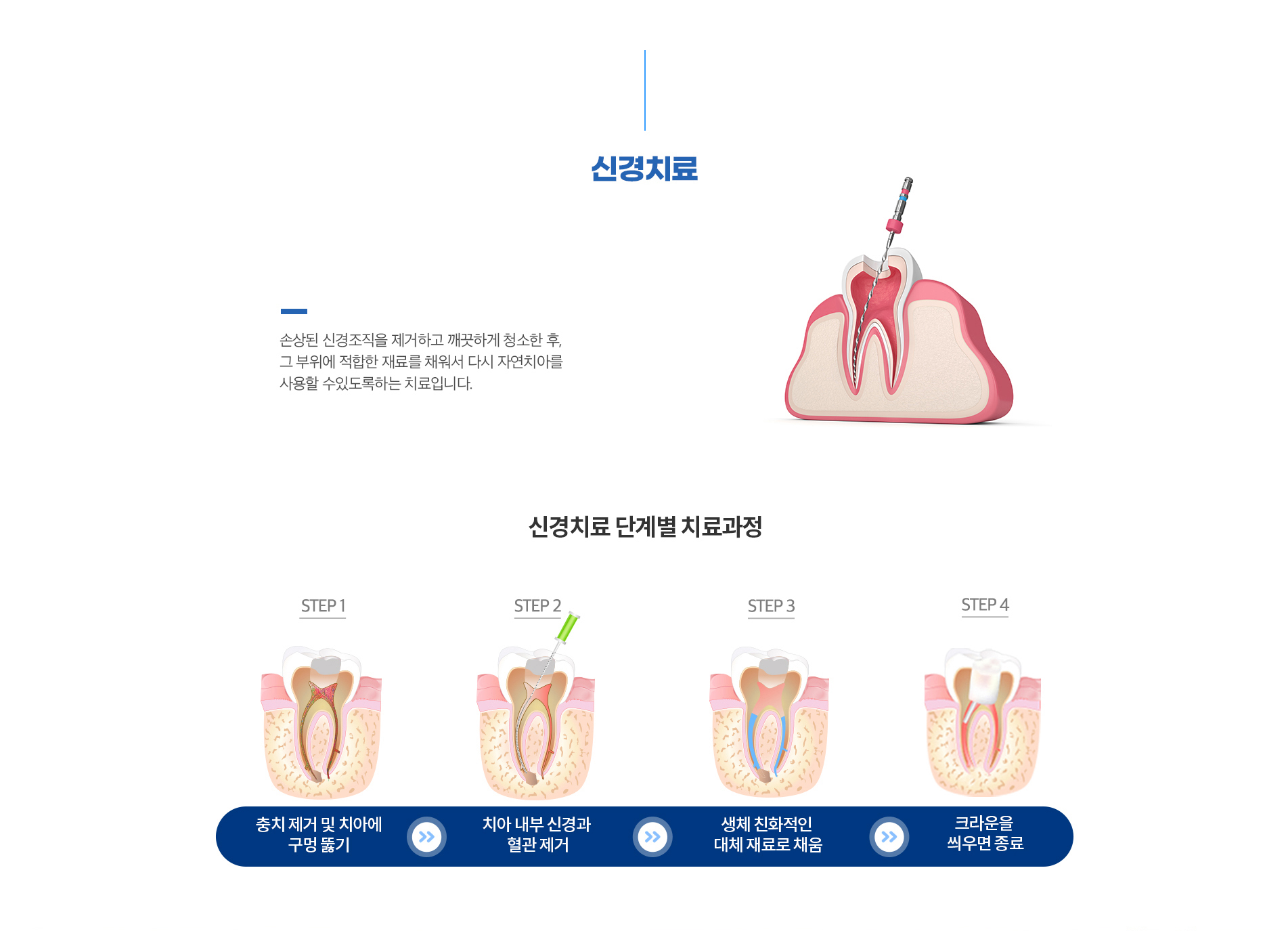 신경치료