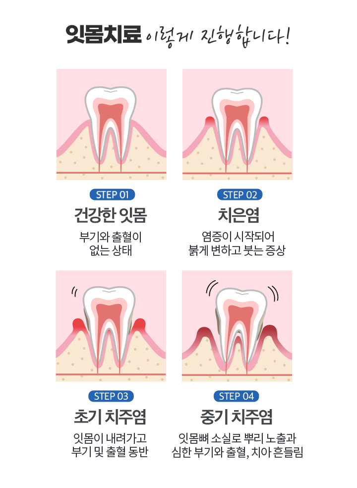 잇몸치료 이렇게 진행합니다