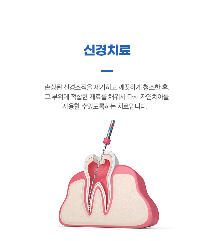 신경치료