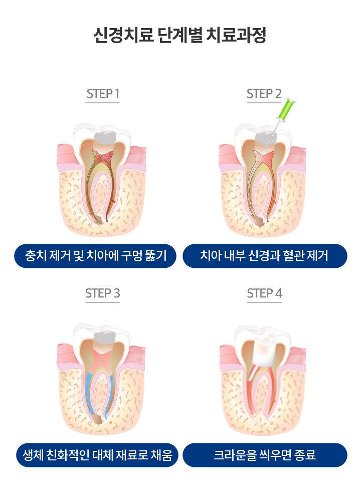 신경치료 단계별 치료과정